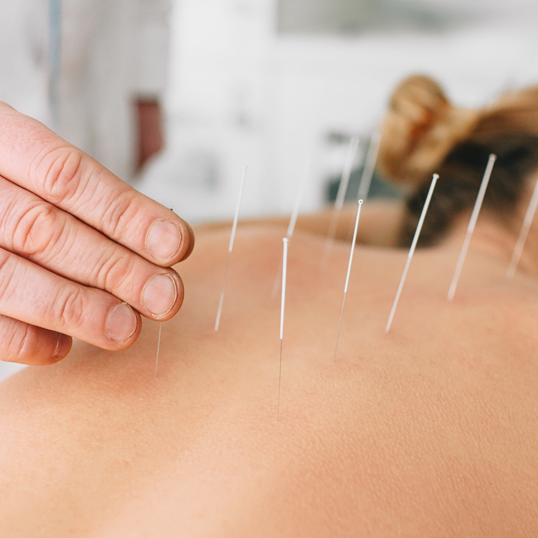 Acupuncture