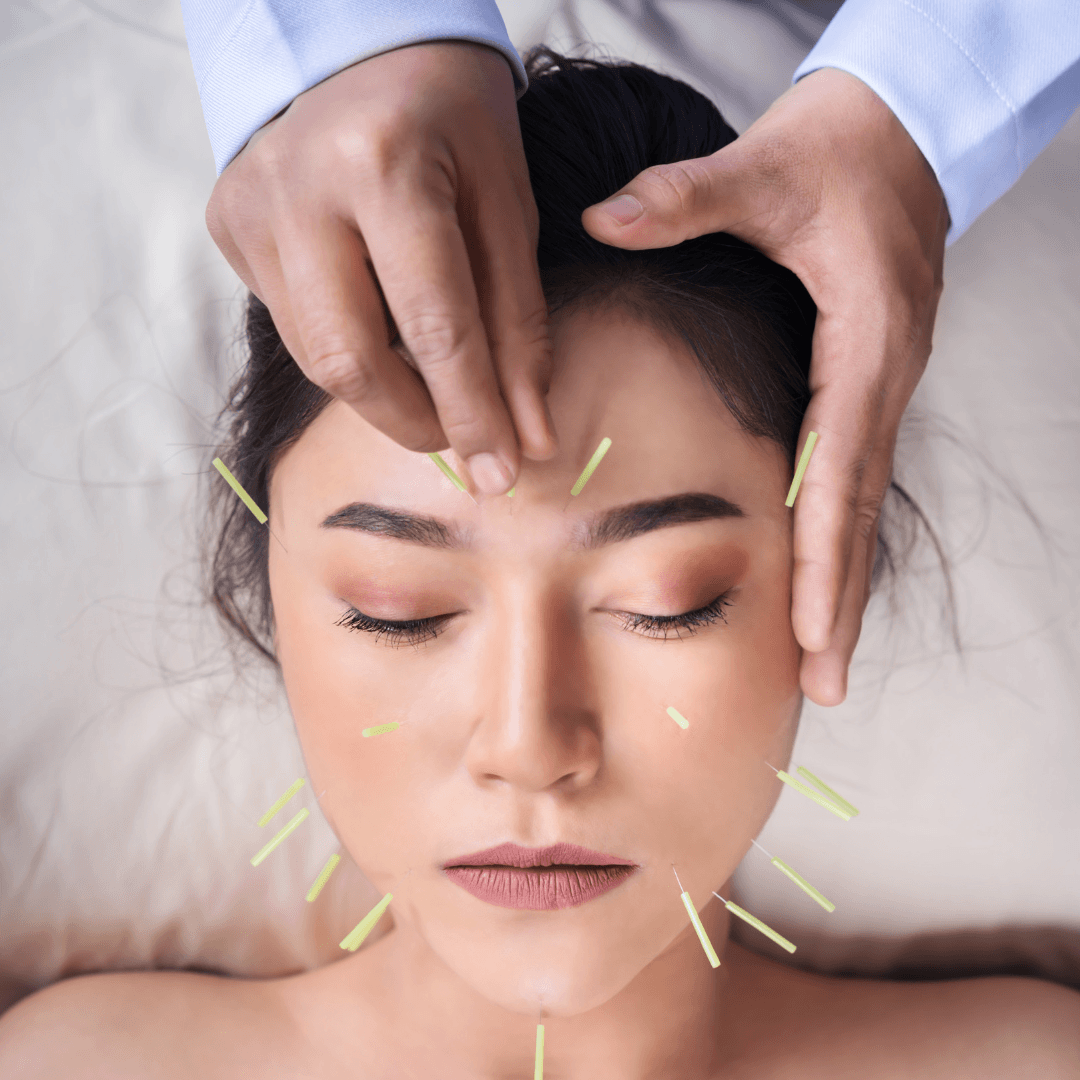 Natural Healing Therapies For Migraines - Acupuncture